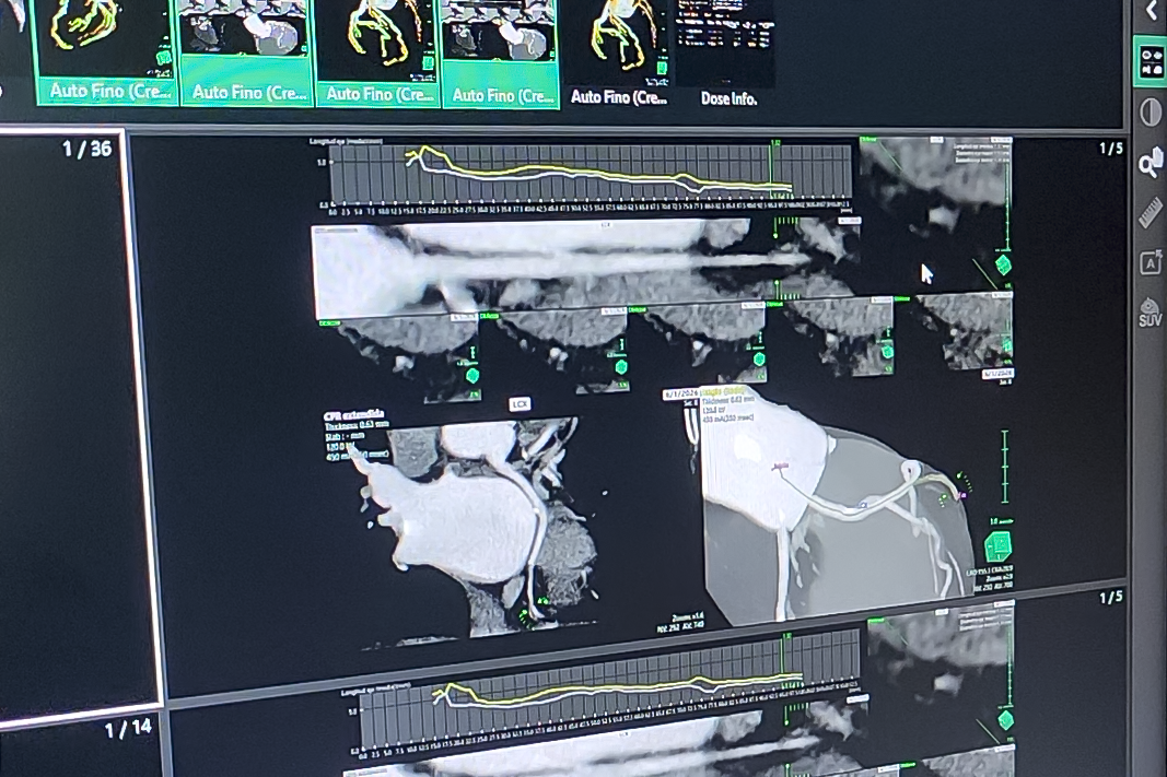 Hospital Regional Coyhaique fortalece prestaciones cardiovasculares con realización de AngioTAC coronarios